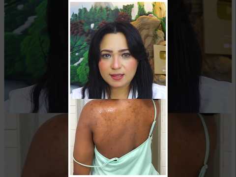 حبوب الظهر والمؤخرة !