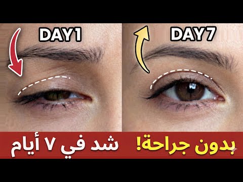 علاج ترهل الجفون طبيعياً في 7 أيام | شد العيون بدون عملية