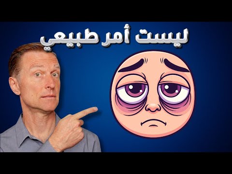 ماذا تخبرك الهالات السوداء حول العين عن حالة الجسم من الداخل | كيف نتخلص منها بدون كريمات