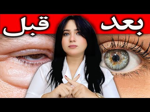 مشروب طبيعي يخلّصك من انتفاخ تحت العين واحتباس الجسم في يومين !