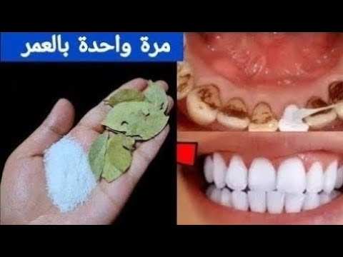 أقسم بالله ‼️لن تحتاج للذهاب لطبيب الأسنان ‼️لتبييض الأسنان واسقاط الجير ‼️سيسقط لوحده بدون رجعة