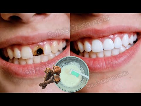 وداعا لرائحة الفم الكريهة واصفرار الأسنان للأبد علاج الجير نهائيًا✨️💯