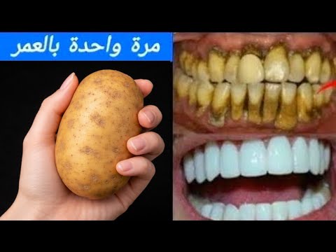 حبه بطاطس‼️قسما بالله لن تحتاج للذهاب لطبيب الأسنان مرة اخري‼️تبييض الأسنان في ثواني