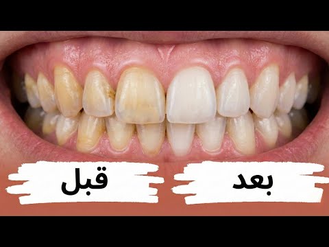 تبييض الأسنان في المنزل بطريقة د.بيرج