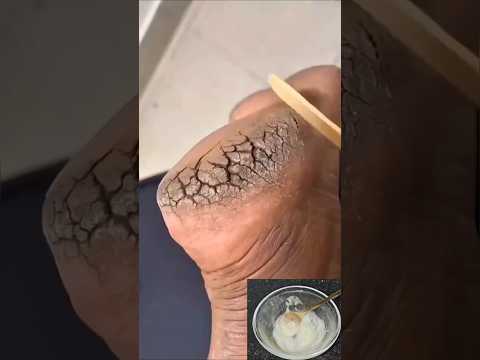 علاج مشكلة الجلد الميت المزعجة  والضوافر الغائرة في الجلد  للأبد✨️ #recipes #اكسبلور