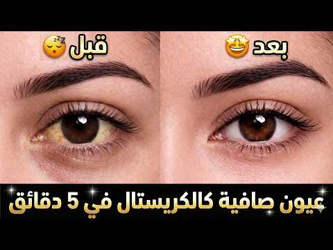 احصلي على عيون لامعة كالماس في 5 دقائق 💎 تبييض بياض العين وإزالة الاحمرار (بدون قطرة)