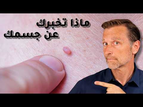 تخلص من السنطة أو الثالول بليلة واحدة