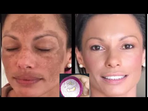 اخلط البصل مع نشا الذرة للحصول على بشرة صافية، مشدودة وخالية من التجاعيد والخطوط الدقيقة/بوطوكس