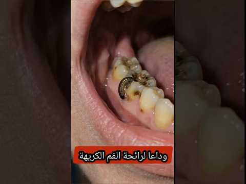 علاج رائحه الفم الكريهه والتسوس والجير ودعي دكتور الأسنان للأبد #recipes #تبييض_الاسنان