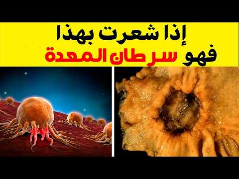 🛑 10 علامات مبكرة لسرطان المعدة 🩺 التي يجب أن تعرفها! 🚨 كن على دراية وقلل المخاطر!