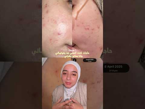 الجزء الاول – حاجات كنت اتمني حد يقولهالي وانا بعالج بشرتي من الحبوب والتصبغات