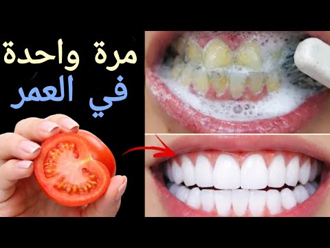 اقسم بالله ‼️لن تحتاج للذهاب الى طبيب الأسنان لتبييض الاسنان وإسقاط الجير ‼️سيسقط لوحده بدون رجعه