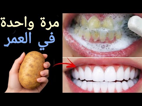 اقسم بالله ‼️لن تحتاج للذهاب الى طبيب الأسنان لتبييض الاسنان وإسقاط الجير ‼️سيسقط لوحده بدون رجعه
