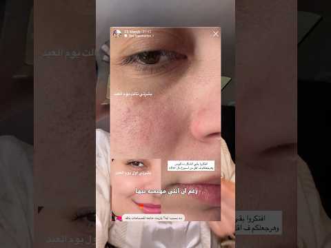 ازاي بوظت حاجز بشرتي بمنتجات بشرتي متعوده عليها !