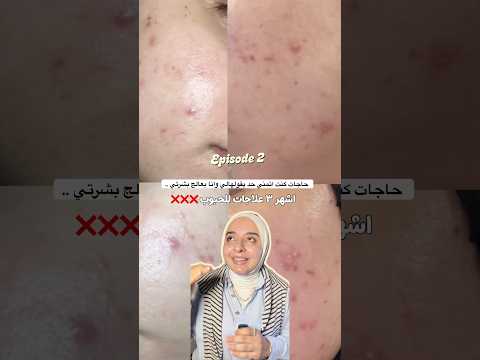 الجزء التاني | حاجات كنت اتمني حد يقولهالي وانا بعالج بشرتي من الحبوب والتصبغات