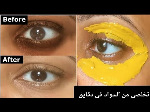خلال 15 دقيقة فقط تخلصي من الهالات السوداء وانتفاخ و ترهل الجفون وكل التجاعيد حول العين ستختفي