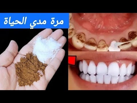 اقسم بالله ‼️ لن تحتاج للذهاب لطبيب الأسنان ‼️وإسقاط الجير ‼️سيسقط لوحده بدون رجعة