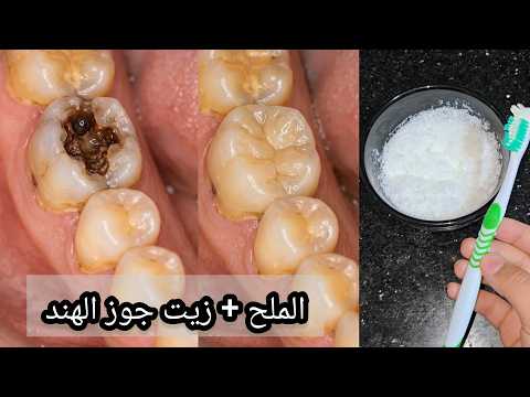 بياض الأسنان في دقائق وإزالة الجير المتراكم بوصفة منزلية فعالة ومكونات موجودة في كل بيت